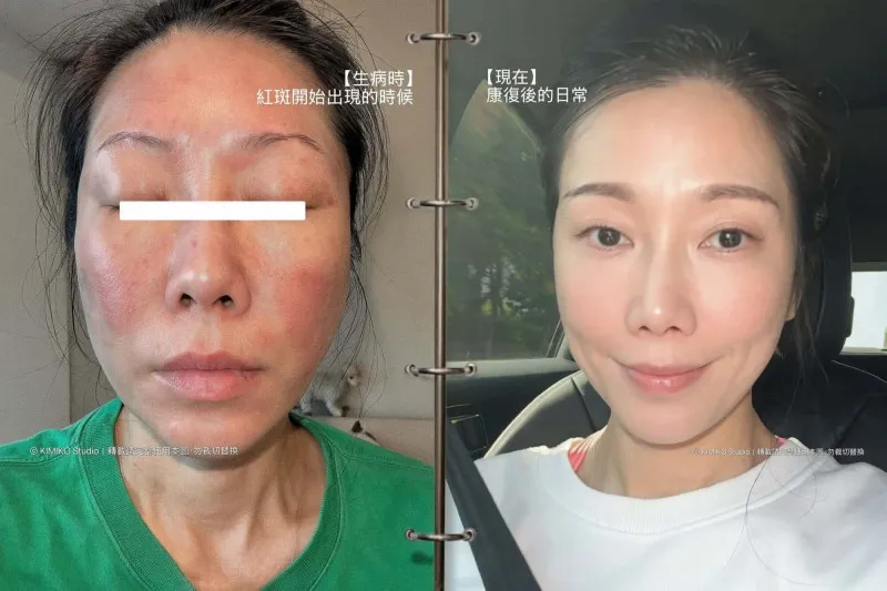 KIMIKO嚴重過敏險致命 環境塵蟎超標是元凶 cover