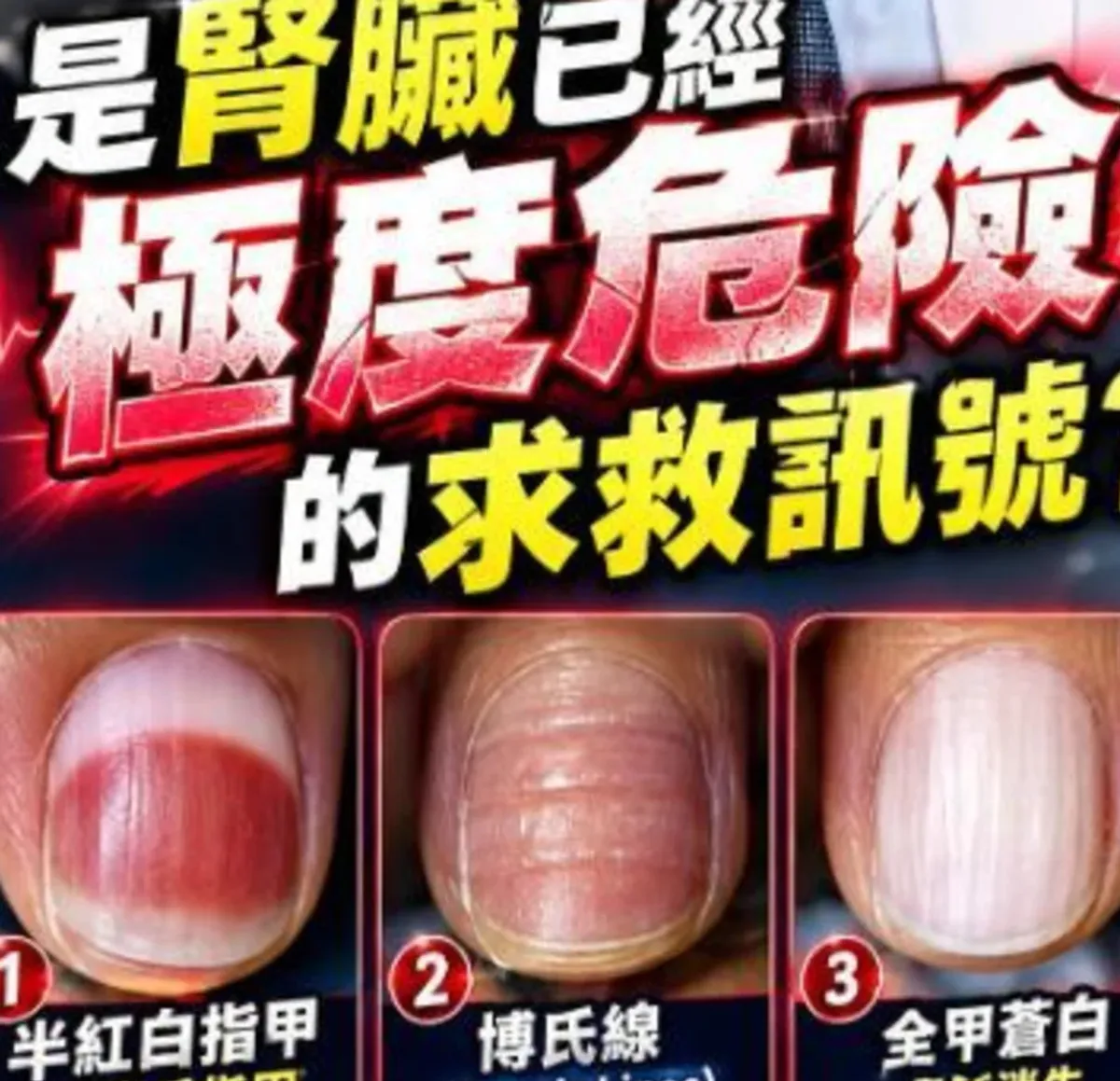 指甲出現三種變化可能是腎衰警訊醫師提醒留意 cover